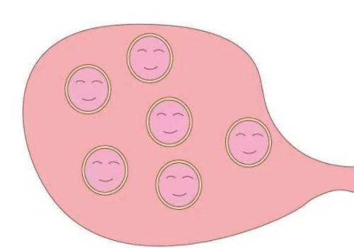 杭州代怀生男孩机构：﻿输卵管积水会影响试管婴儿吗,输卵管积水怎么引起的
